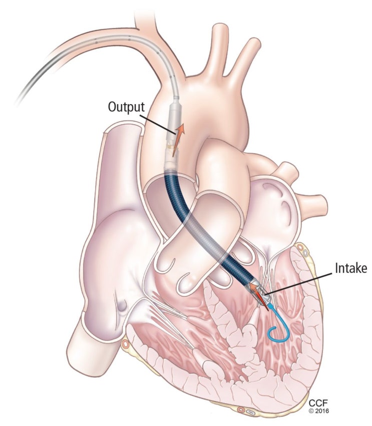 Impella 임펠라 : 네이버 블로그
