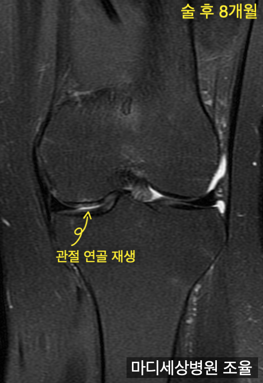 무릎 관절연골 결손(articular cartilage defect)으로 미세천공수술(microfracture) 후 8개월차 ...