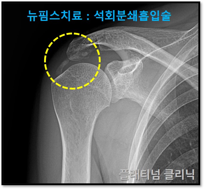 (플래티넘클리닉) 석회성 건염은  비수술로 충분히 치료 가능합니다!
