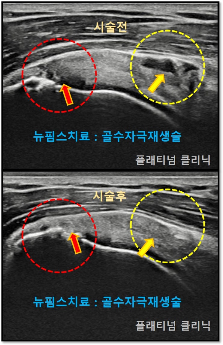(플래티넘클리닉) 회전근개 부분파열 : 골수자극줄기세포재생술로 치료합시다!