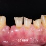 아래 앞니 브릿지 & 세라믹 크라운 - 치아 노화(마모,파절,깨짐)로 인해 다수 보철치료