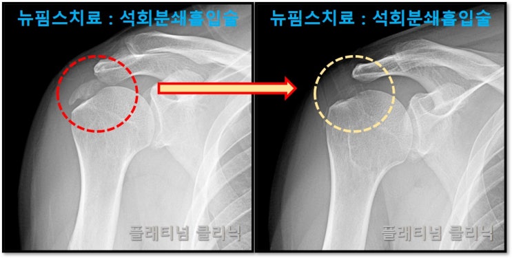 (플래티넘클리닉) 어깨 석회성 건염 : 근본적으로 석회분쇄 흡입술을 통해 수술없이 치료!!