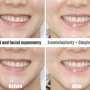 치아 교정 후에도 웃을 때 비대칭, 치아성형과 치은절제술로 얼굴비대칭 개선효과