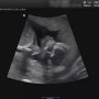 육아일기 : 임신 16주차, 기쁨이 성별 확인