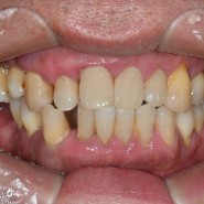 치아뼈가 다 녹아서 치아가 빠질꺼 같은데 어떻게 치료해야 할까요?/임플란트/이천치과