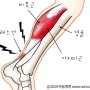종아리 통증(근육 뭉침, 근육 파열, 다리 쥐나는 이유, 경련 증상)