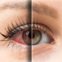 쿠마™] 안구건조증을 해결하는 영양제 조합 (Dry eye syndrome)