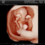 [임신일기] 임신12주차 1차기형아검사