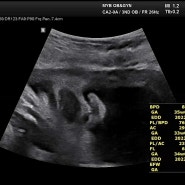 [임신 일기] 임신36주차 태동검사