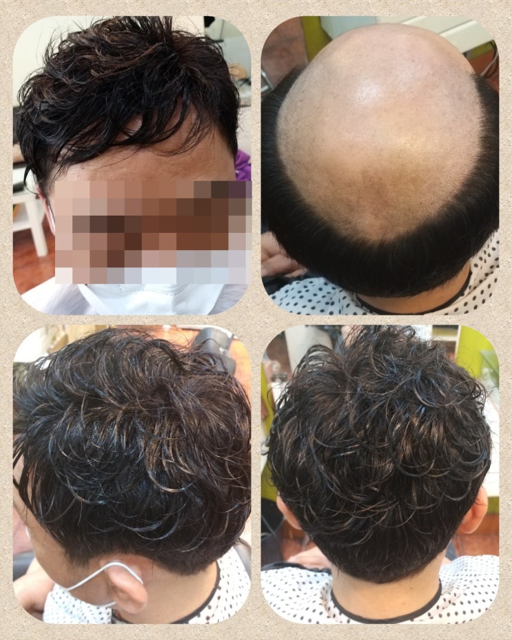 고정식남자인모가발 : 네이버 블로그