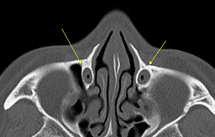 정상 NLD (nasolacrimal duct) 구조 및 CT 소견, NLD obstruction 시 drain (J-tube ...