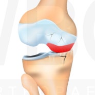 관절염의 치료 휜다리수술 과 카티스템 그리고 줄기세포치료