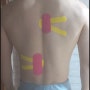 척추측만증(척추옆굽음증, Scoliosis) 테이핑