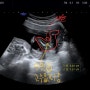 태아성별확인 초음파각도법 / 임신 12주 아기성별확인