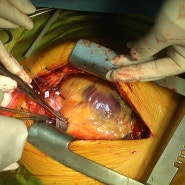 세계 최초의 인간 대상 돼지 심장 이식 실험 두 달 만에 종료