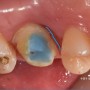 [수영구 치과] 부러진 치아 ‘치관확장술’로 치료한 사례와 비용 케이스