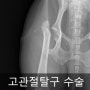 고관절탈구 대퇴골두절단 FHNO