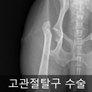 고관절탈구 대퇴골두절단 FHNO