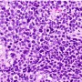 소세포-신경내분비형 전립선암, 전혀 다른 양상/불량한 예후
