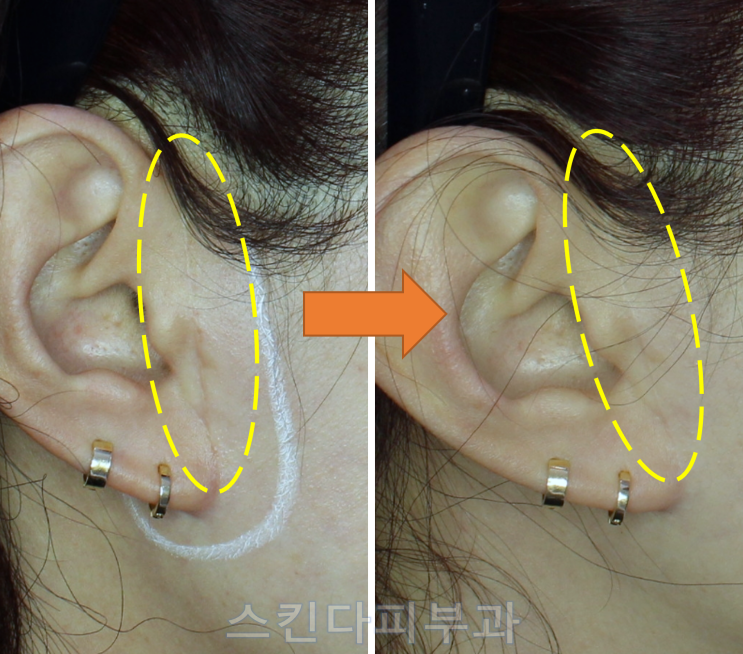 안면거상흉터 미니거상 이마거상수술흉터 레이저복원치료 사례-피부과전문의 닥터라이언 : 네이버 블로그