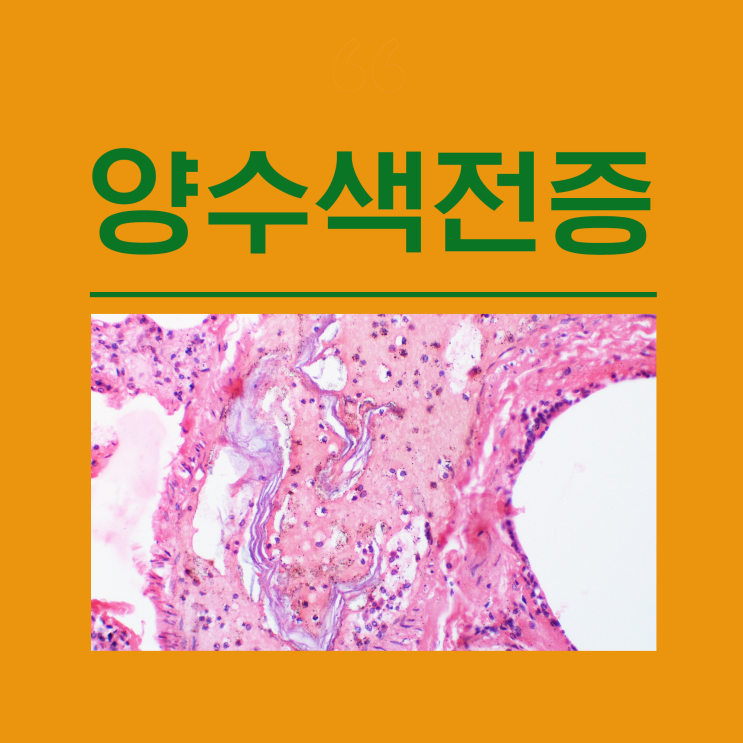 양수색전증 원인 치료 분만 제왕절개 유산 자연 인공 혈액응고장애 양수검사 소파술 임신중절수술 : 네이버 블로그