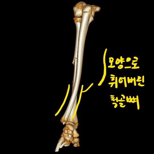 소아 팔뼈 골절!요골 몸통골절 및 척골뼈 나무줄기 골절 : 네이버 블로그