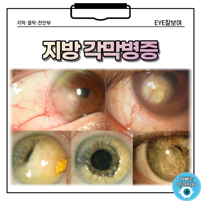 각막에 지방이 쌓이는 '지방각막병증' : 네이버 블로그