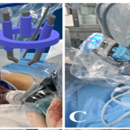 대전 을지대학병원 산부인과 로봇 근종 수술 방법