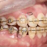 치아교정기간이 심하게 늘어나면 안되는 이유