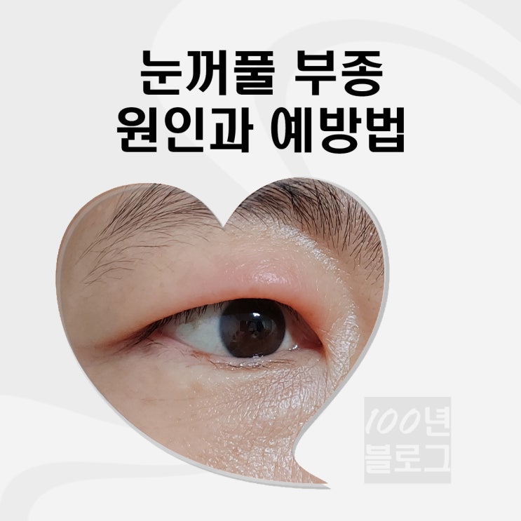 눈꺼풀 부음 부종 원인 질환과 예방법 : 네이버 블로그