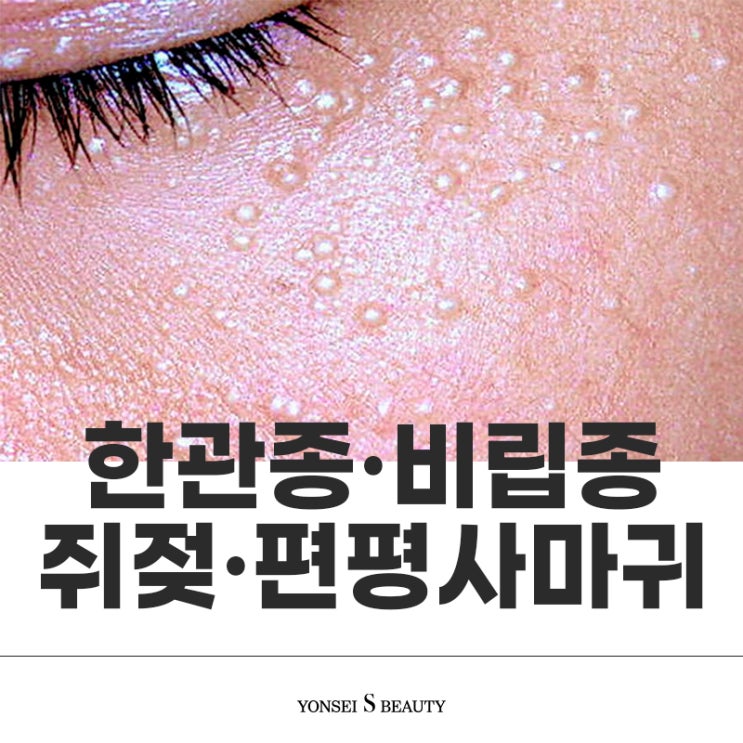 세종시 연세에스 비립종/한관종/쥐젖/편평사마귀 구분방법 : 네이버 블로그