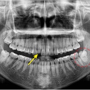 중랑구 부러진 앞니 신경치료와 사랑니발치