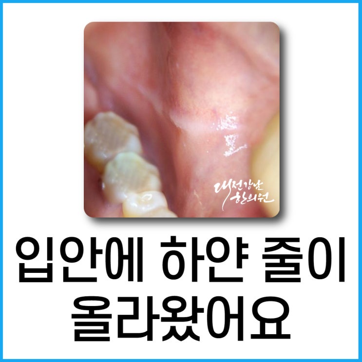 협점막 백선: 입안에 하얀줄이 나있어요 : 네이버 블로그