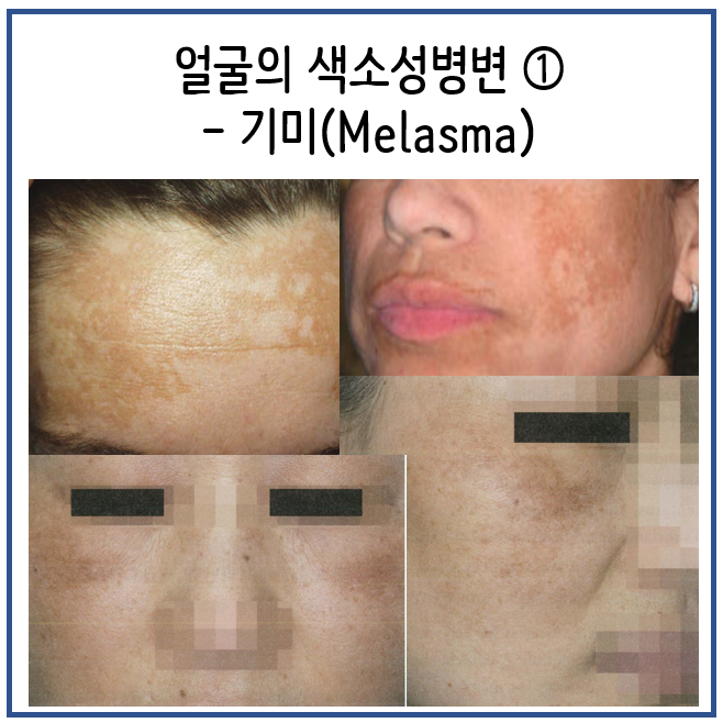 얼굴에 갈색 반이 생겼어요 - 얼굴의 색소성병변(1) : 기미(Melasma), 원인/증상/치료/예방 : 네이버 블로그