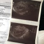 에스텔라 한푹 국제병원에서 아기집 확인하다! (임신 5주차)