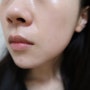 피부일기 : 여름철 피부관리 추천조합 (하이드라페이셜,아스트로돔페이셜 솔직 찐후기!)