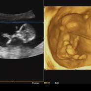 임신 12주 초음파검사,1차 기형아검사 피검사 목투명대 코뼈여부 성별 각도법