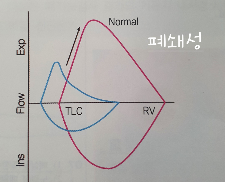 [호흡기] 객혈 원인 / 폐기능 검사 / 흉수감별 / 천식 / 결핵 / 나머지 폐질환 정리표 : 네이버 블로그