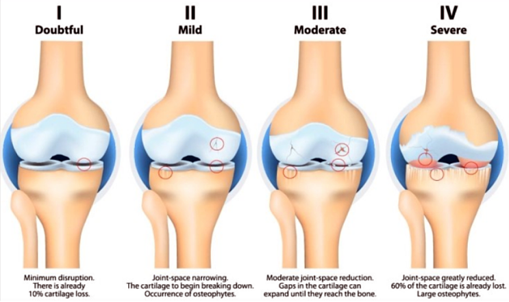 [무릎] KLG (Kellgren Lawrence Grade) / patellofemoral OA 의 Iwano ...