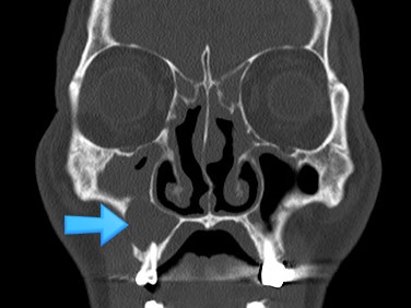 술후성 협부 낭종 (Postoperative cheek cyst) 수술 : 네이버 블로그