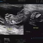 육아일기 : 임신 22주차, 기쁨이 정밀검사