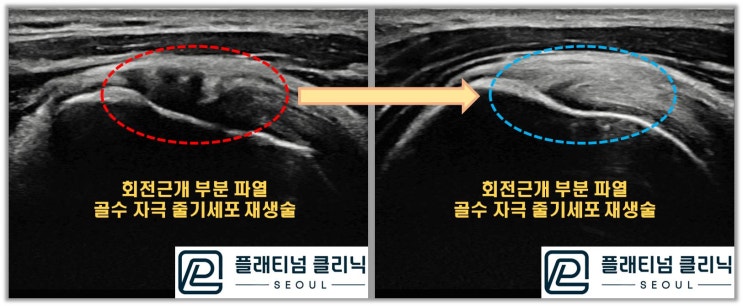 (플래티넘클리닉) 회전근개 부분파열에 대한 치료는?