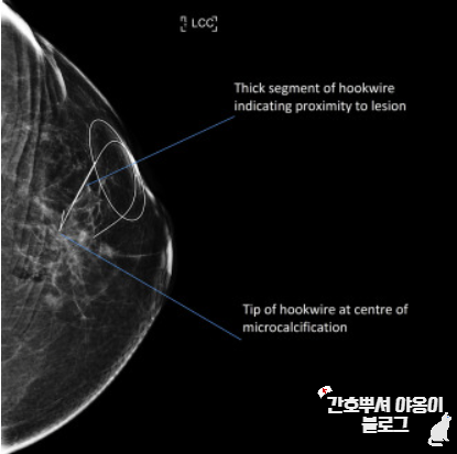 검사, NPO 동의서 여부 4 - Hook wire guided localization, US Guided biopsy ...