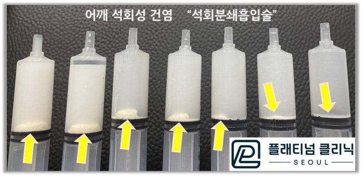 (플래티넘클리닉) 어깨 석회성 건염 어떻게 진단하고 치료할까요?