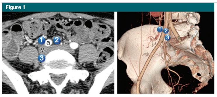 common, external, internal iliac lymph nodes (LN)의 위치, CT 소견 : 네이버 블로그