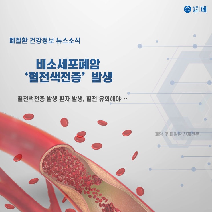 비소세포폐암 '혈전색전증' 발생 ··· 혈전 유의해야 : 네이버 블로그