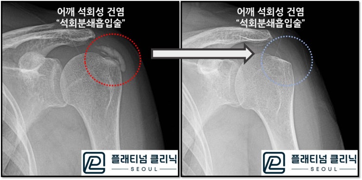 (플래티넘의원) 어깨 석회성 건염 - 3년간의 고통을 날려버리다. "석회분쇄흡입술"