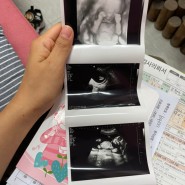 임신 15주 배크기 성별 2차기형아검사 비용 진료비 배통증 허리통증 엉덩이통증(환도선다) 다리저림