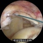 넘어진 후 발생한 외상성 회전근개파열로 시행한 관절경 회전근개 이중봉합술 / 제이본정형외과 권제호