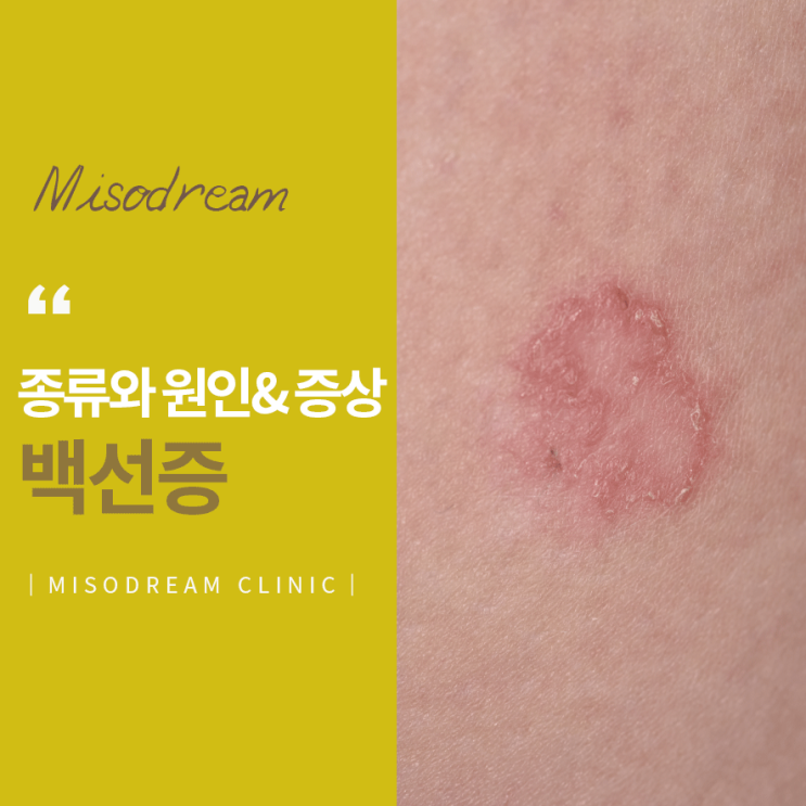 성남피부과 추천 백선증이란? 백선증의 종류와 원인, 증상 알아보자! : 네이버 블로그